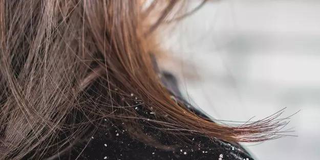 Kepeğe ne iyi gelir?