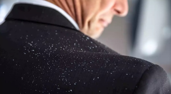 Kepek nasıl geçer? | Kepek nasıl temizlenir?