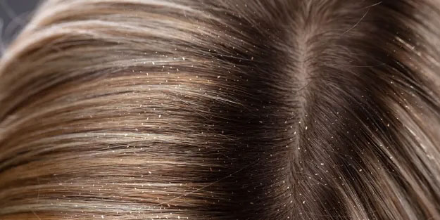 Kepek oluşumunun nedenleri ve kurtulmak için ipuçları