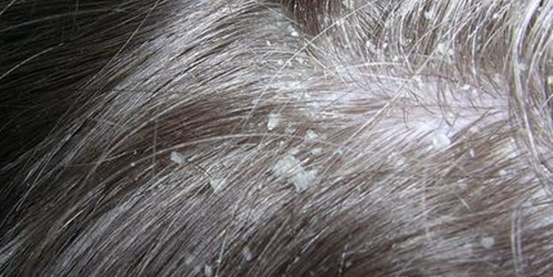 Kepek şampuanlarındaki tehlike!