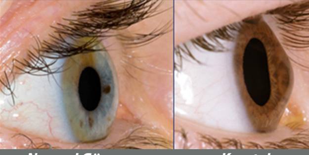 Keratokonus nedir, belirtileri nelerdir? Kişiye özel keratokonus tedavisinin önemi nedir?