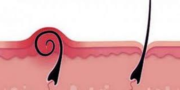 Kıl dönmesi riski!