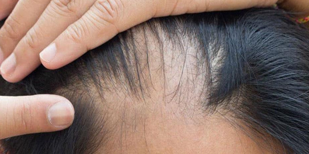 Kimse bilmiyor saç dökülmesini durduruyor ve yeni saç çıkartıyor! Dökülmeyi geçiren karışım ne ile yapılmalı?