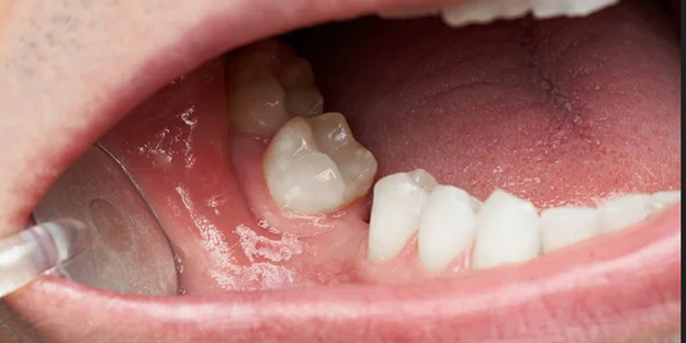 Kimse farkında değil! Eksik dişler sağlığımızı nasıl etkiler