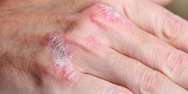 Kışın bu hastalığa çok dikkat edin!