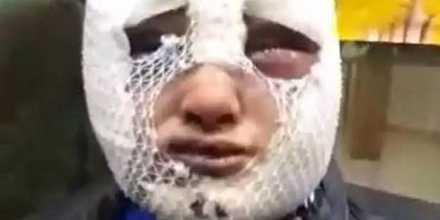 Kız arkadaşının yüzüne kızgın yağ döken zanlı için yeni karar