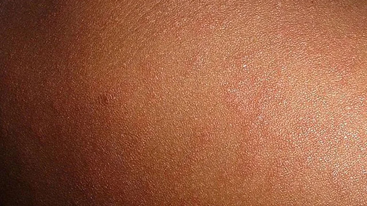 Kızamık geri döndü! Çok sayıda hasta var! Avrupa ayağa kalktı!