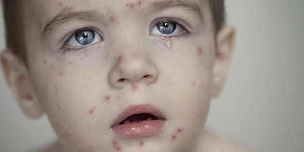 Kızamık nedir nasıl geçer, bulaşır mı?