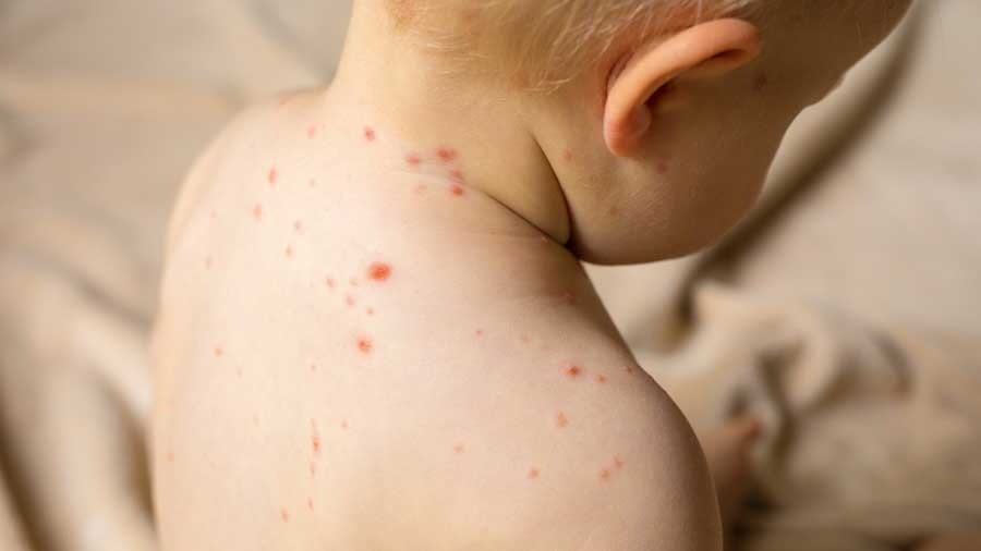 Kızamık vakalarında korkutan artış!