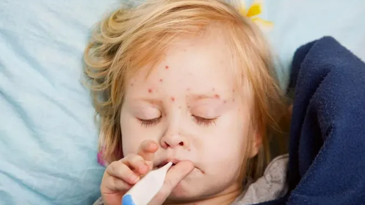 Kızamık vakalarında korkutan artış!