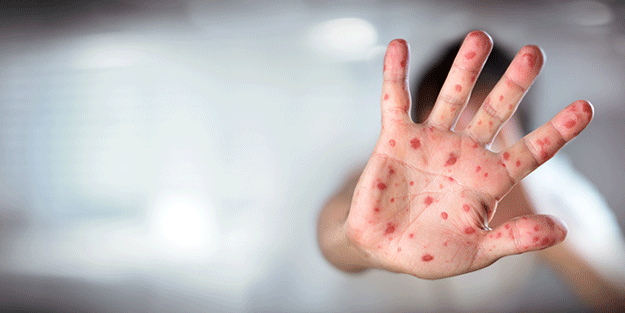 “Kızamık vakalarındaki artışın en önemli sebebi aşı karşıtlığı”