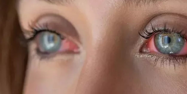 Kızarıklık, kaşıntı, yanma: Hem çocuklarda hem de yetişkinlerde görülüyor! Aman dikkat