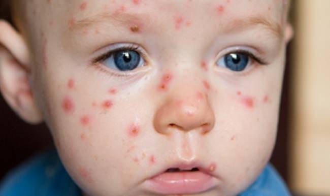 Kızıl hastalığı İngiltere’ye geri döndü