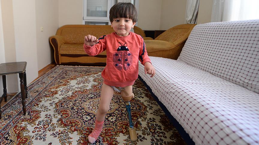 Kızına kendisi protez bacak yaptı