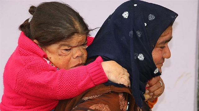 Kızını 36 yıldır sırtında taşıyor