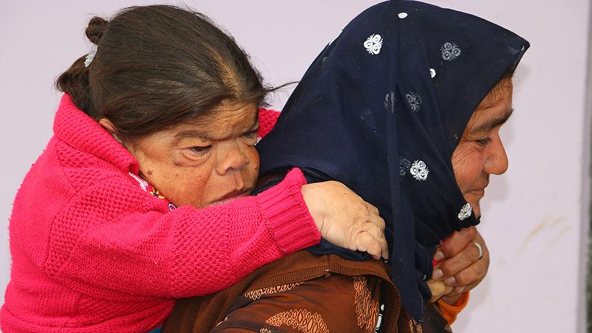 Kızını tam 36 senedir sırtında taşıyor