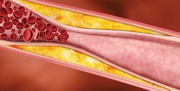 Kolesterolünüz yükseliyorsa... Bu nedenlere dikkat!