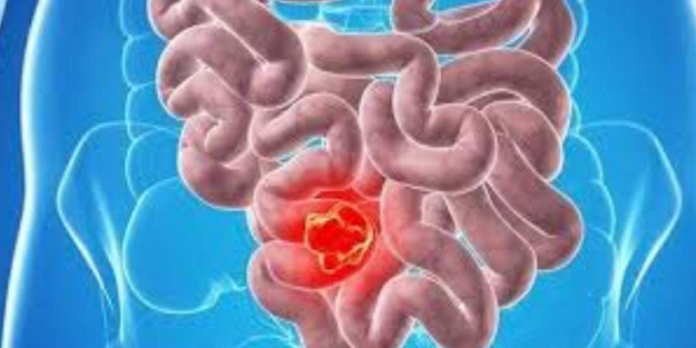 Kolon kanseri nedir? Kolon kanserinin bilinmesi gereken 5 erken belirtisi