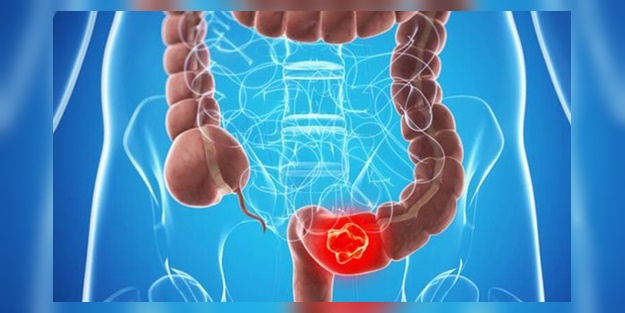 Kolon kanseri nedir, ne kadar sürer? Kolon kanseri belirtileri tedavisi