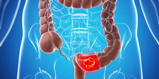 Kolon kanseri tanısı nasıl konur?