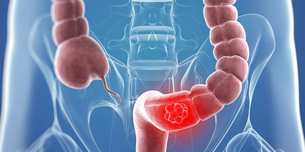 Kolon kanserinden uzak kalmak için 10 öneri