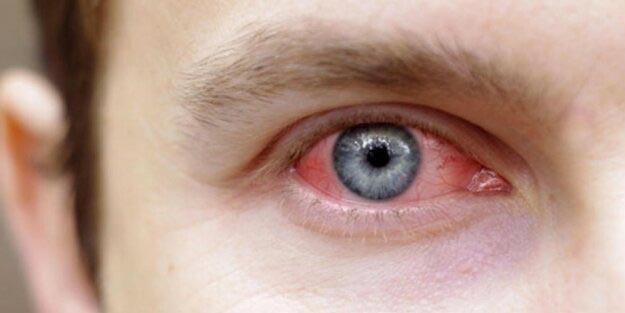 Konjoktivit nedir? Konjoktivit belirtileri neler?