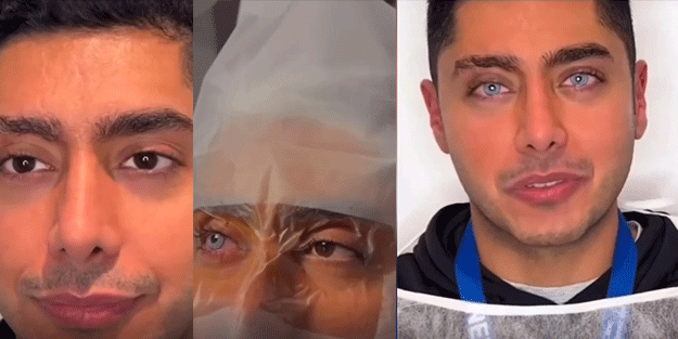 Kör kalma riskine rağmen ille de mavi göz dedi