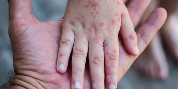 Korkulan oldu... Maymun çiçeğinden Avrupa'da ilk ölüm!