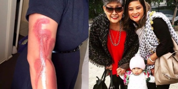 Korkunç iddia: Akıllı telefon kolunu yaktı