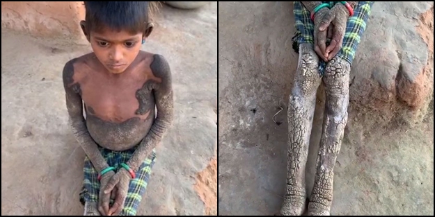 Korkunç olay: 7 yaşındaki kız çocuğu taşlaşıyor!