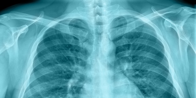 Kritik haber! İnsan akciğerinde ilk kez rastlandı