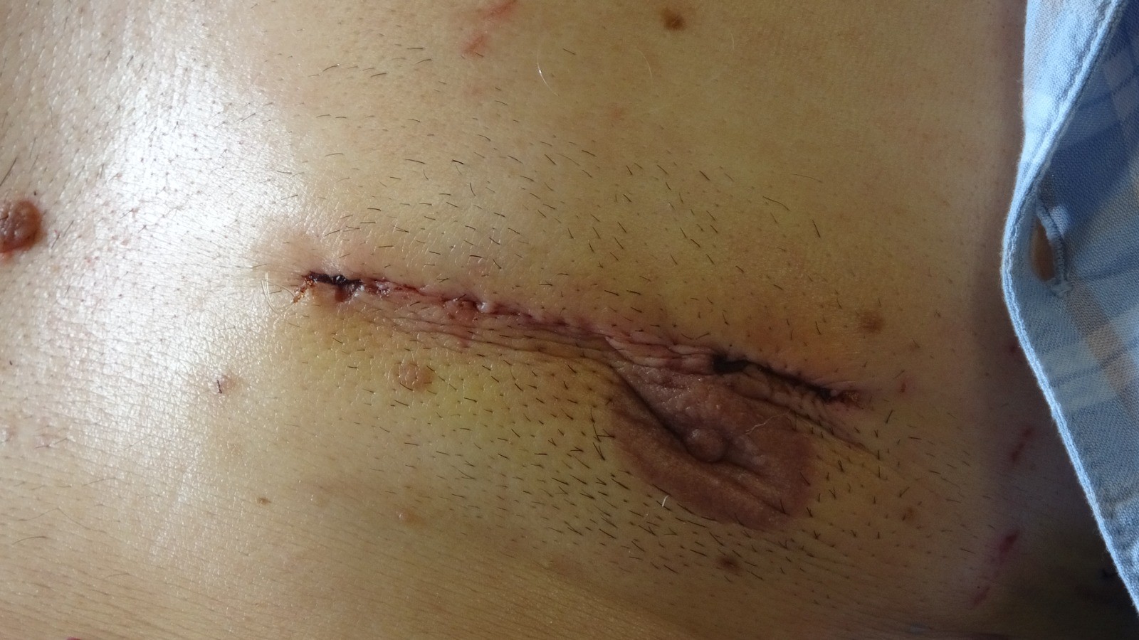 Küçük kesi ile gelen sağlık! Hastalar 3, 4 günde taburcu olabiliyor