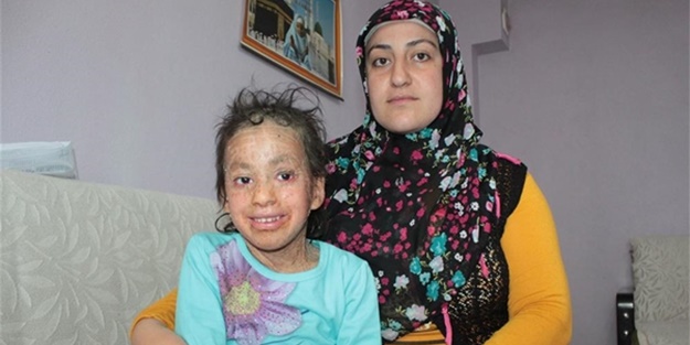 Küçük kızın derisi balık pulu gibi dökülüyor