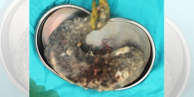 Küçük kızın midesinden 2 kilo saç çıktı!