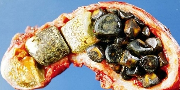 Küçük safra taşı daha tehlikeli