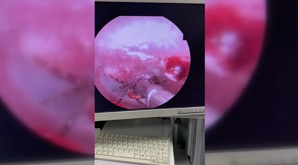 Kulak ağrısı şikayetiyle hastaneye gitti! İnanılır gibi değil bakın kulağından ne çıktı