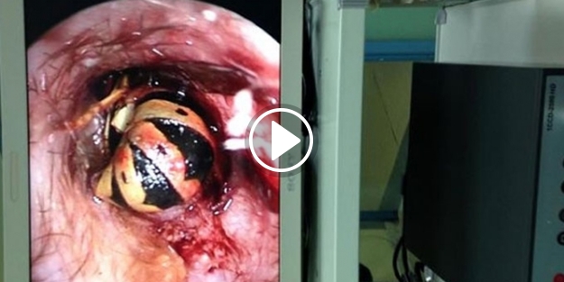 Kulaklarından çıkanlar herkesi şoke etti!