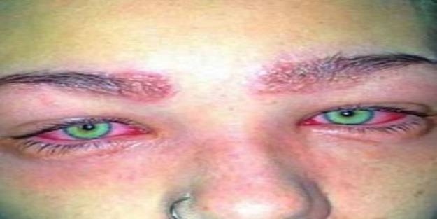 Kullandığı kozmetik ürün kör ediyordu