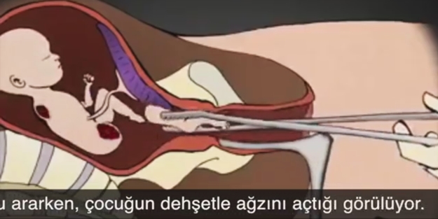 Kürtaj cinayettir! İşte kürtaj sırasında bebeğin hissettikleri...