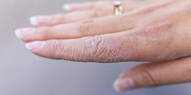 Kuru ve çatlak eller için evde uygulayabileceğiniz 5 yöntem
