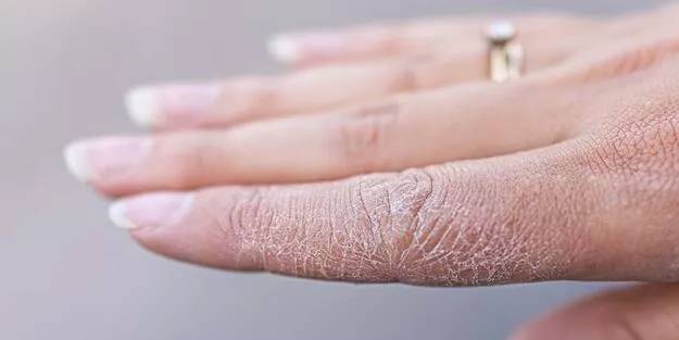 Kuru ve çatlak eller için evde uygulayabileceğiniz doğal çözümler