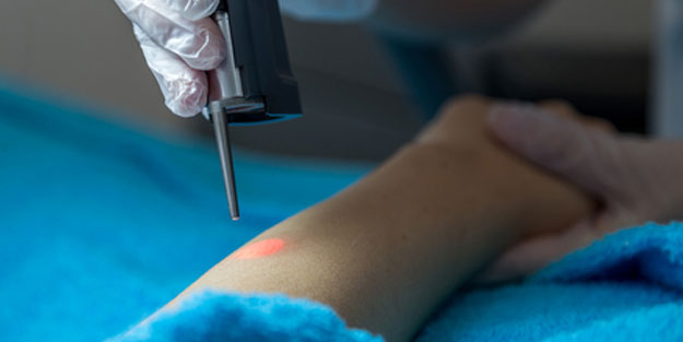 Lazer epilasyon kimler için uygundur? İşte lazer epilasyon ile ilgili tüm detaylar...