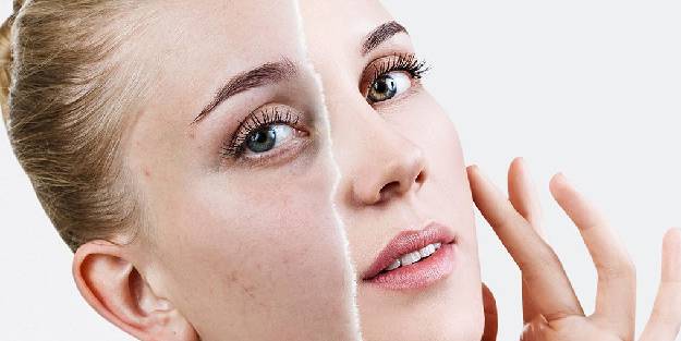 Leke tedavileri uzun solukludur ve sabır gerektirir