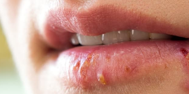 Limon! Ağızda çıkan uçuklar kabusunuz olmasın! Biz bir sır, kesin çözüm verdik: Beklemesi yeter