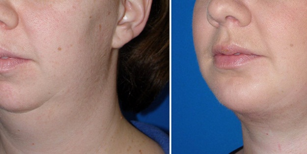 Limonla doğal gıdık eritme