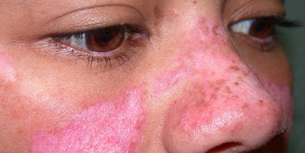 Lupus hastalığı daha çok kadınlarda görülüyor