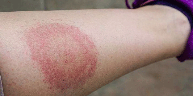 Lyme hastalığı nedir, belirtileri nelerdir? Lyme hastalığının tedavisi var mı?