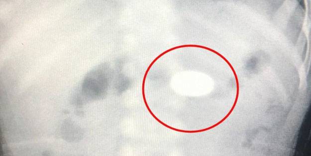  İki adet 50 kuruş yutan bebek hastanelik oldu