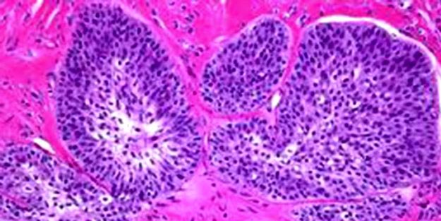 Malign mezenşimal tümör nedir? Malign mezenşimal tümör belirtileri neler tedavisi nedir?