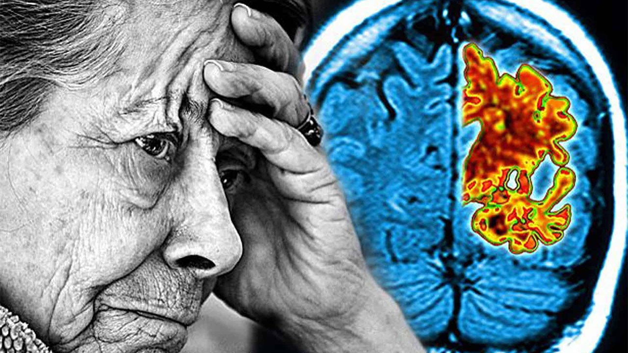 Maydanoz nasıl Alzheimer'a iyi geliyor?